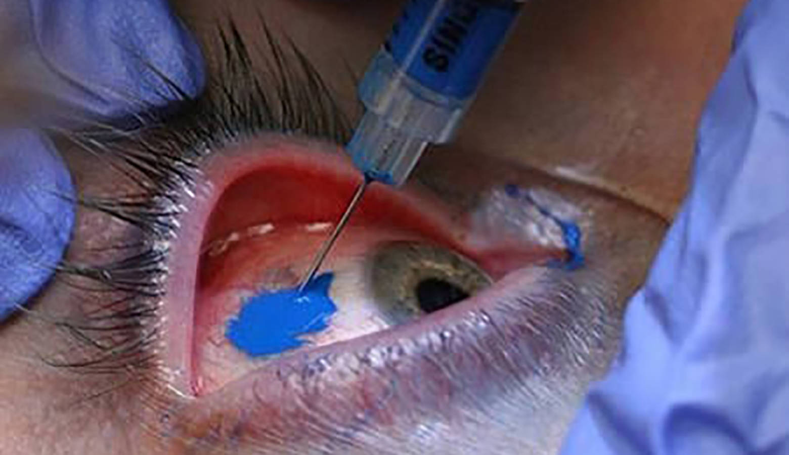 Sclera tattoo (IZATRINI/Flickr)